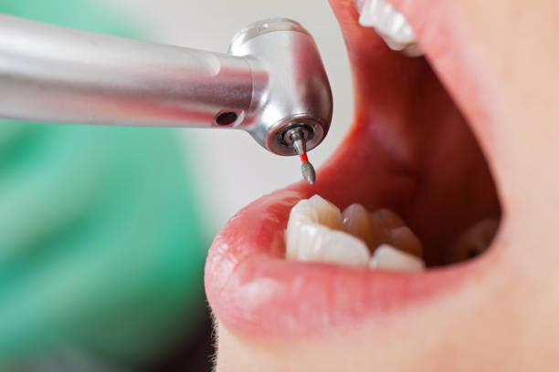 Best Emergency Wisdom Tooth Extraction in Mission Hills, KS
